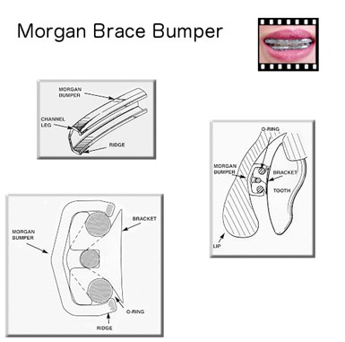Morgan Brace Bumpers